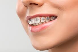 Teeth Braces Types for Kids How to Make the Right Choice