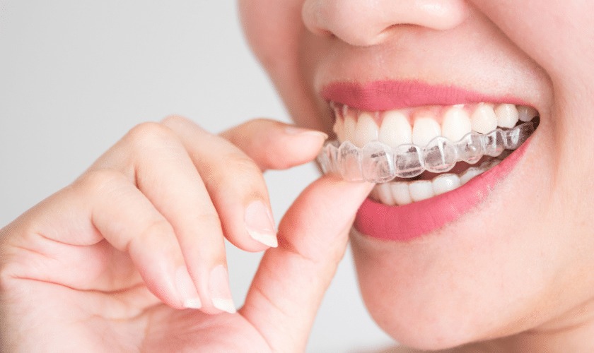 The Ultimate Guide to Transparent Braces Everything You Need to Know